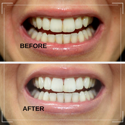cheap teeth whitening near me before and after example 2
