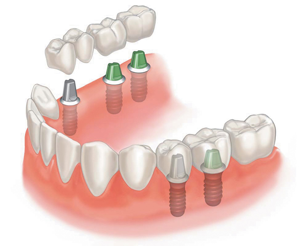 dentist near me for implants with a supported bridge