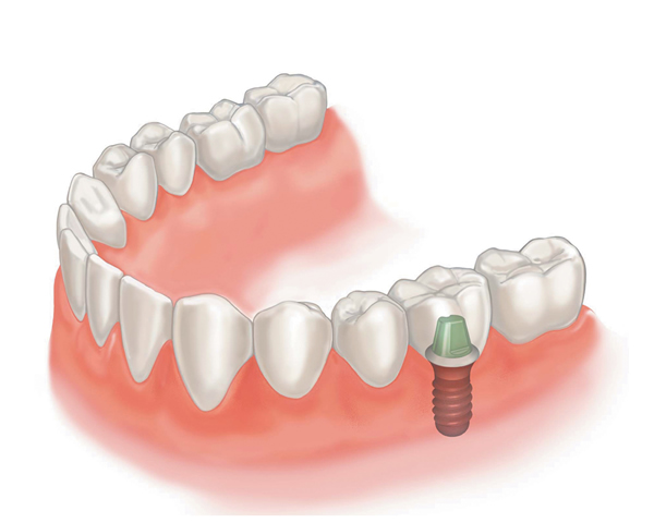 teeth implants near me with supported crown