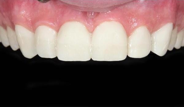smile makeover example after treatment