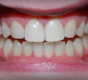 after cheap composite bonding at Edenfield Dental