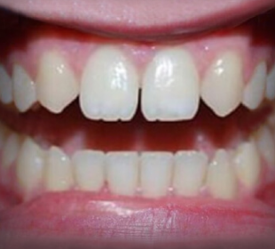 before composite bonding teeth near me