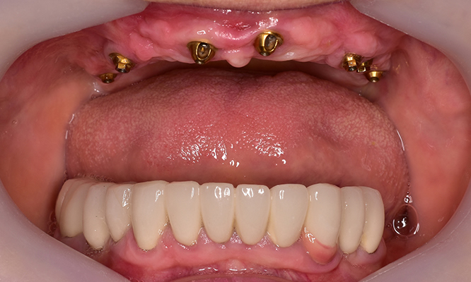Implant supported denture before