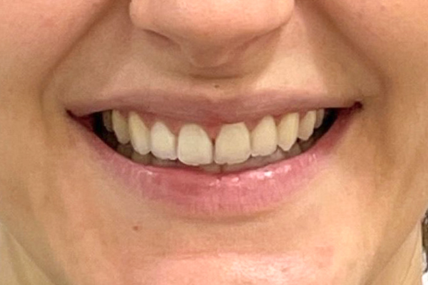 teeth straightening near me in Rochdale