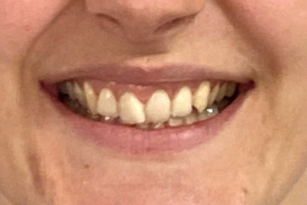 Before Invisalign dentist near me