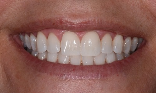 Teeth whitening near me results