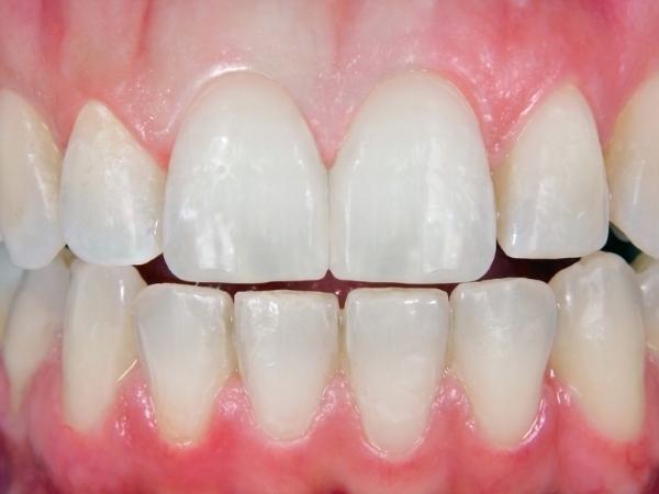 after cheap dental veneers near me at Edenfield Dental