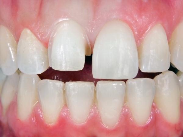 before porcelain veneers near me at Edenfield Dental